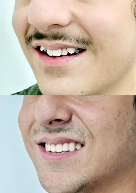 Before and after smile transformation for Zain, Age 27 with clear aligners