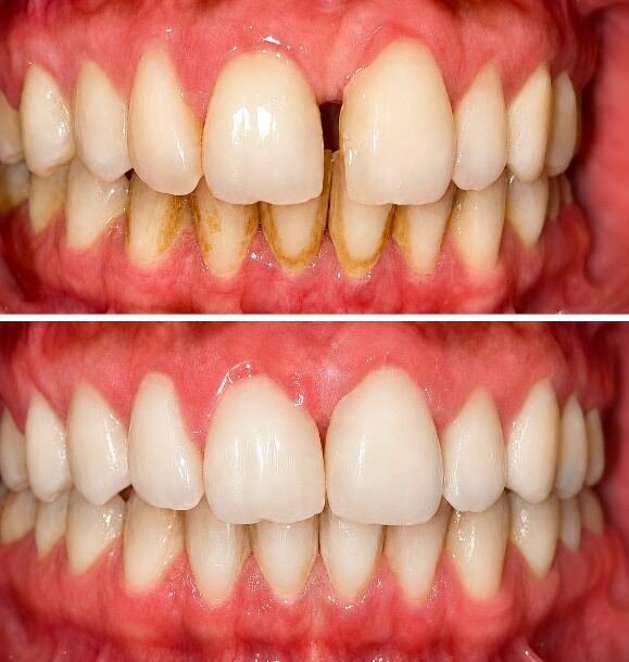 Before and after smile transformation for Zain, Age 28 with clear aligners