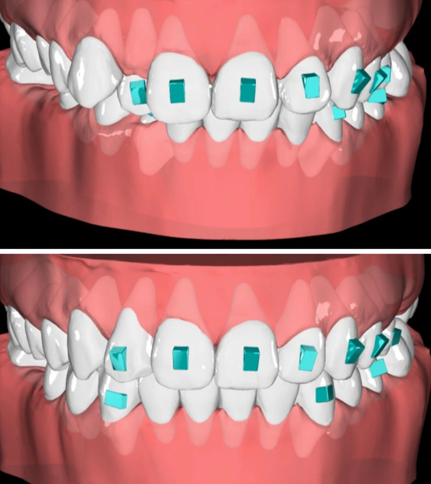 Digital treatment simulation of aligner trays on a 3D tooth model