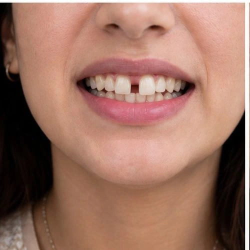Teeth becoming more crooked over time